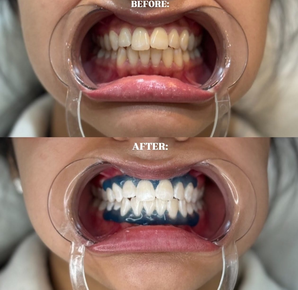 Teeth Whitening Options, Cost, and Expert Tips in Noida, India